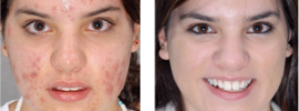 acne no more book