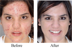 acne no more book